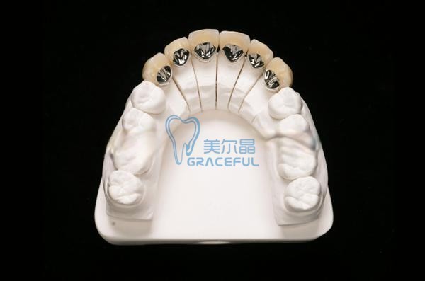 普通(tōng)烤瓷