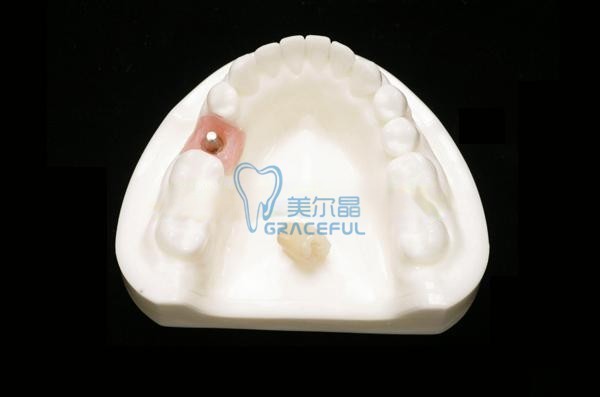 Dental implant